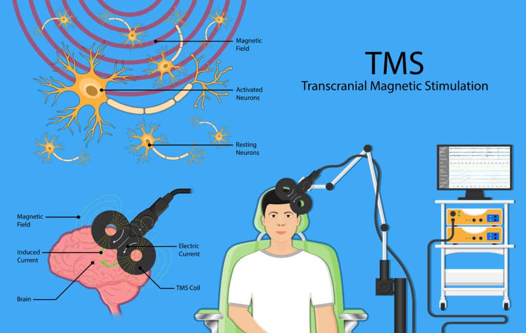 tms therapy