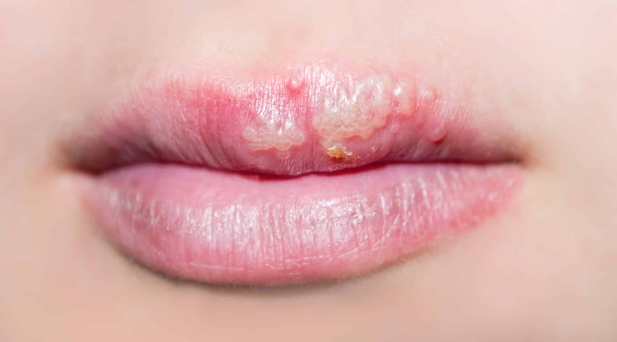 How Much Lysine Can You Take In A Day For Cold Sores