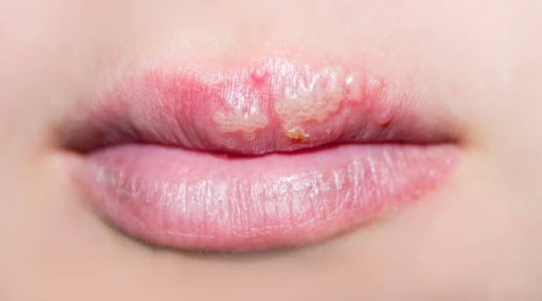 How to Take Lysine for Cold Sores: A Cheat Sheet for People Prone to Cold Sores